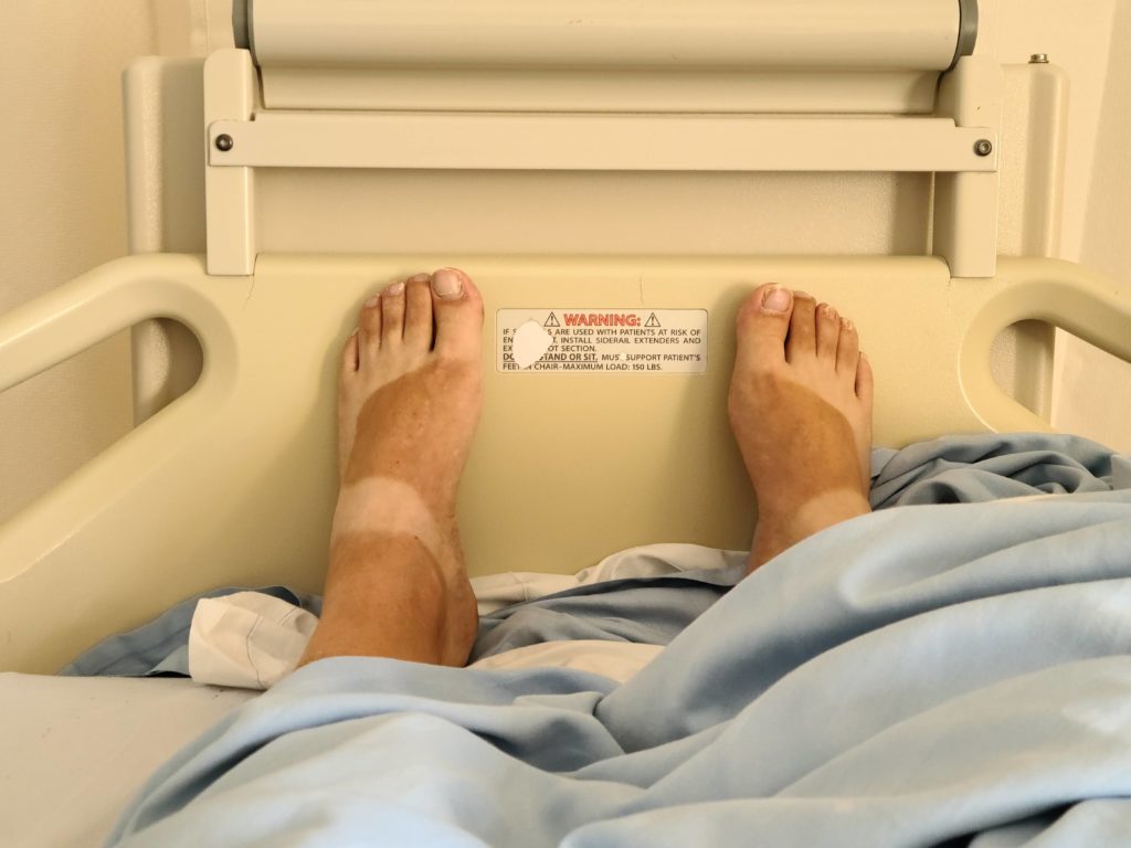 Preston's feet with a sandal tan in a hospital bed